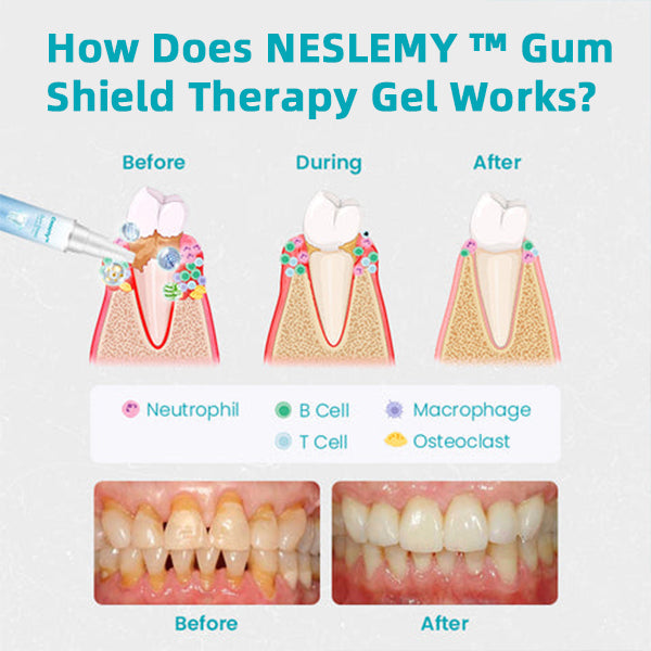 🔥Last Day Promotion 80% OFF-NESLEMY™ Gum Shield Therapy Gel